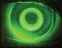 Figure 10. Bulls-eye fluorescein pattern in keratoconus (Global OK design).