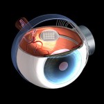 Picture showing the position of the Bionic receiver implanted on the retina