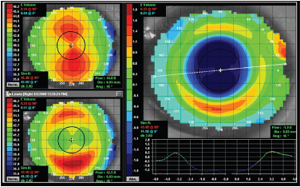 Figure 5. Dual Axis design patient topography. - Courtesy of Patrick J Caroline, FAAO