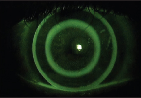 Figure 3. OK Multifocal (Contex). Photo courtesy Patrick J Caroline, FAAO