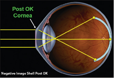 Figure 1. Negative image shell post-orthokeratology treatment.