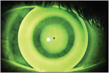 Figure 7. Hyperopic Multifocal Design (Contex).