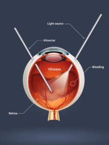 Image showing a vitrectomy procedure