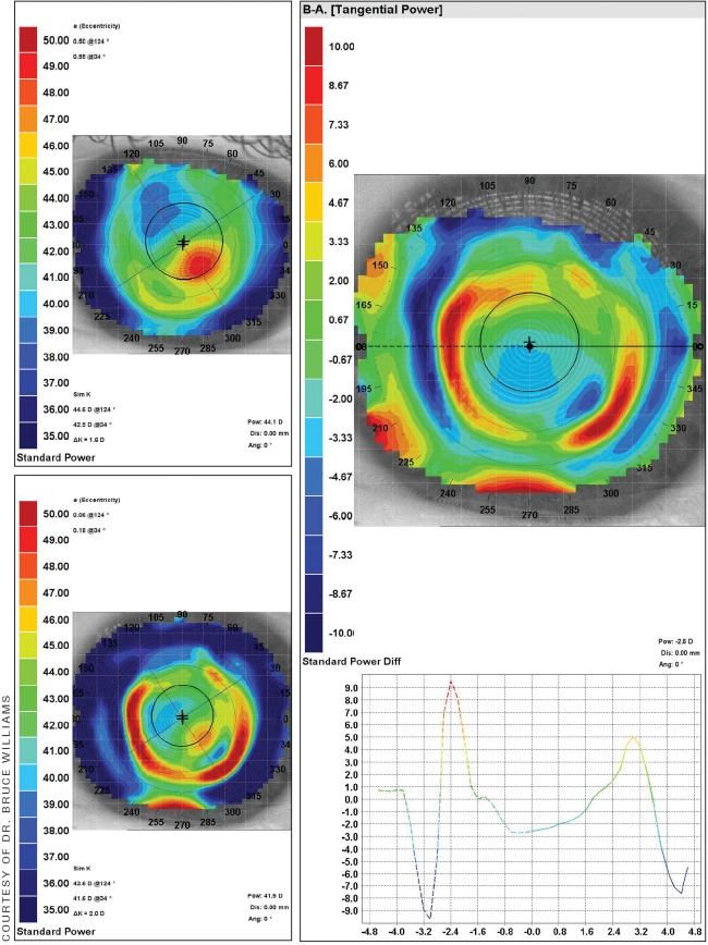 Post Lasik Charl Laas Optometrists