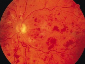Fundus image of a Central Retinal Vein Occlusion