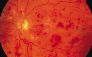 Fundus image of a Central Retinal Vein Occlusion