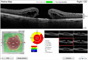 OCT image showing a macular hole