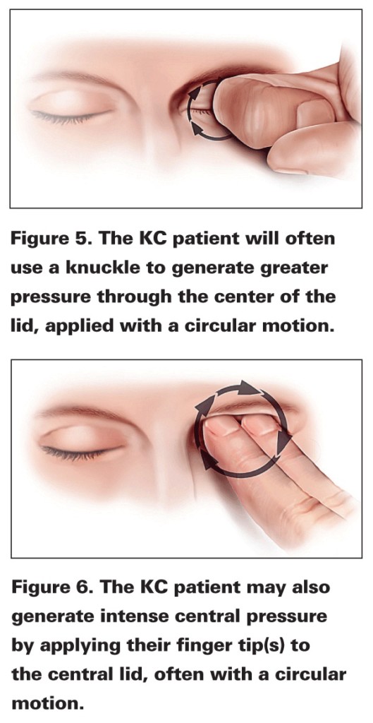 Eye rubbing and Keratoconus Charl Laas Optometrists