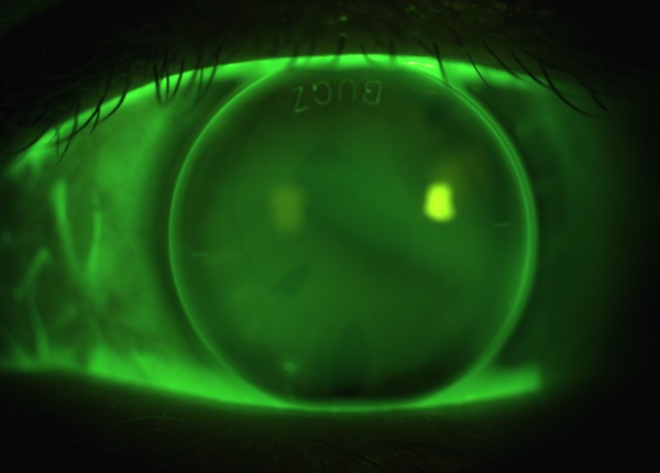 Sodium Fluorescein image of EyeSpace Bespoke Bitoric gas permeable lens fitted on the left eye.